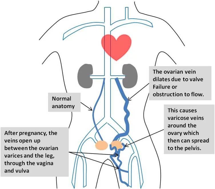 diagram of pelvic congestion syndrome