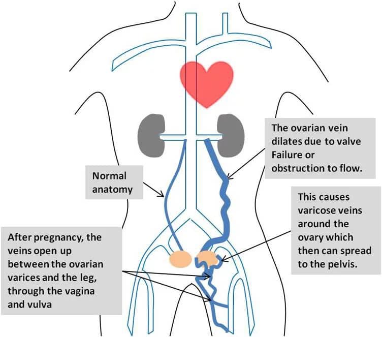 Pelvic Congestion Syndrome - LA Vascular