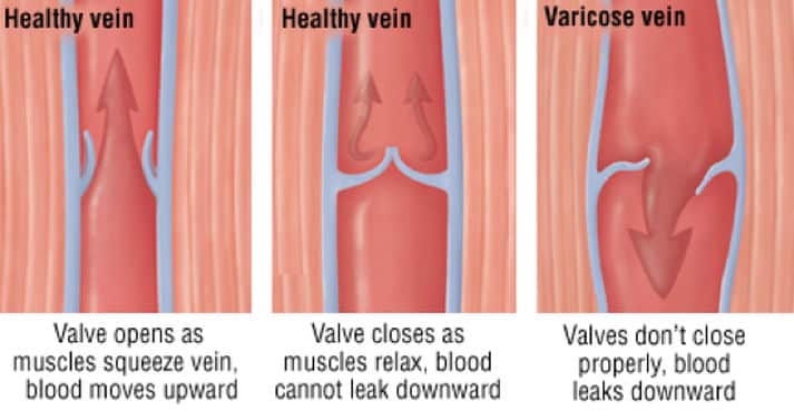 animation comparing healthy veins with varicose veins