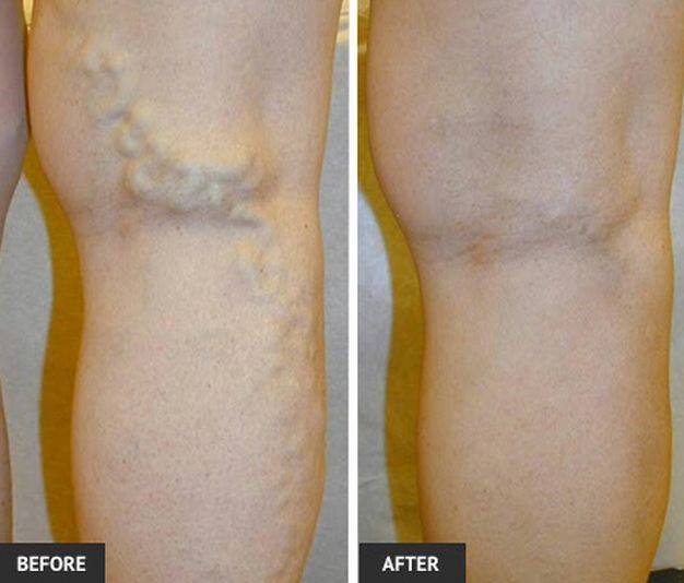 before and after varicose vein treatment