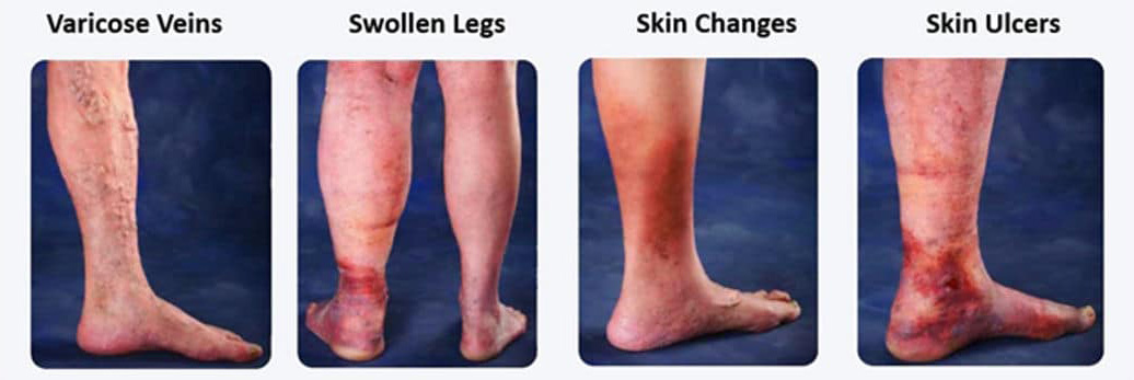 pictures of various vein conditions