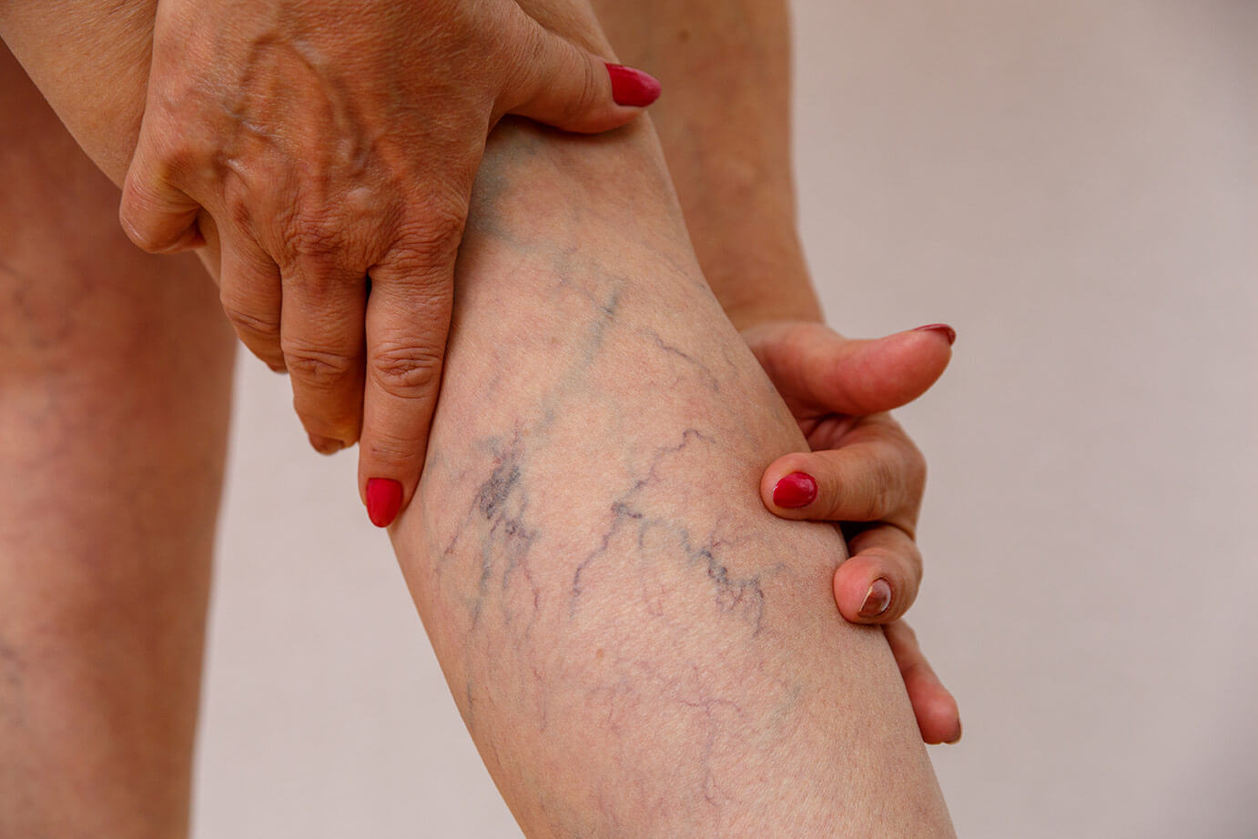 A closeup image of an elderly woman holding her calf and examining spider and varicose veins.