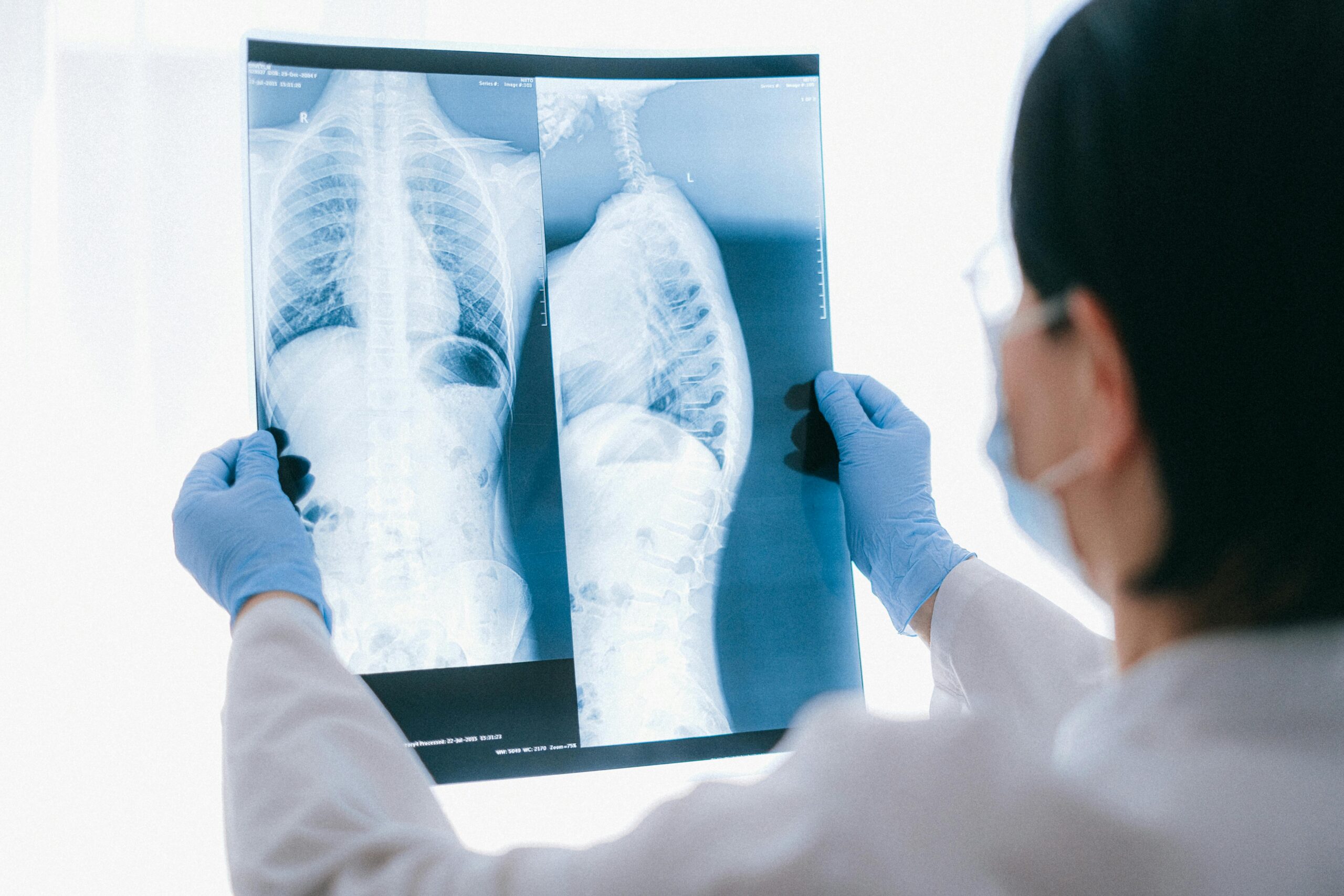 A doctor wearing an operating mask and blue medical gloves holds up an x-ray scan of lungs to examine it.